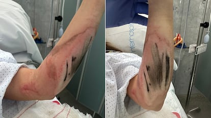 fkhscg4skje6hc5m6pj6bmtd74 La mujer muestra las heridas en el brazo después de ser atropellada.