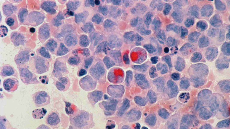 mas-de-18-millones-de-personas-en-el-mundo-moriran-de-cancer-en-2050-un-75-mas-que-ahora